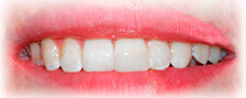 CASE # 1: Emergency Treatment - Fractured Tooth (after) CASE # 1: Emergency Treatment - Fractured Tooth (after)