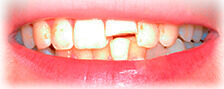 CASE # 1: Emergency Treatment - Fractured Tooth (before) CASE # 1: Emergency Treatment - Fractured Tooth (before)