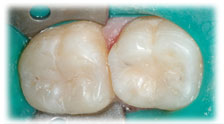 CASE #10: Cosmetic Restoration - White Filling (after) CASE #10: Cosmetic Restoration - White Filling (after)