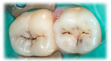 CASE #10: Cosmetic Restoration - White Filling (before) CASE #10: Cosmetic Restoration - White Filling (before)