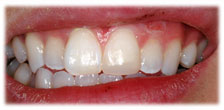 CASE #11: Emergency Treatment - Broken/Chipped Teeth (after) CASE #11: Emergency Treatment - Broken/Chipped Teeth (after)