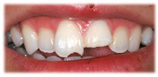 CASE #11: Emergency Treatment - Broken/Chipped Teeth (before) CASE #11: Emergency Treatment - Broken/Chipped Teeth (before)