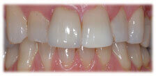 CASE #12: Veneers - Stained Teeth (after) CASE #12: Veneers - Stained Teeth (after)