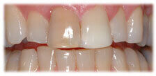 CASE #12: Veneers - Stained Teeth (before) CASE #12: Veneers - Stained Teeth (before)
