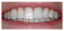 CASE #13: Emergency Treatment - Fractured Tooth (after) CASE #13: Emergency Treatment - Fractured Tooth (after)