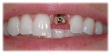 CASE #13: Emergency Treatment - Fractured Tooth (before) CASE #13: Emergency Treatment - Fractured Tooth (before)