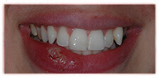 CASE #15: Emergency Treatment - Fractured Tooth (after) CASE #15: Emergency Treatment - Fractured Tooth (after)