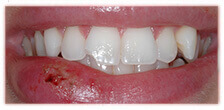 CASE #15: Emergency Treatment - Fractured Tooth (before) CASE #15: Emergency Treatment - Fractured Tooth (before)