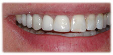 CASE #16: Broken/Fractured Tooth (after) CASE #16: Broken/Fractured Tooth (after)