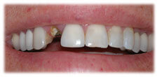 CASE #16: Broken/Fractured Tooth (before) CASE #16: Broken/Fractured Tooth (before)