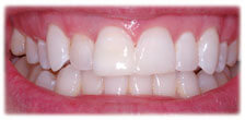CASE #17: Emergency Treatment - Broken Teeth (after) CASE #17: Emergency Treatment - Broken Teeth (after)