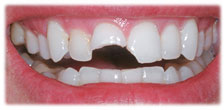 CASE #17: Emergency Treatment - Broken Teeth (before) CASE #17: Emergency Treatment - Broken Teeth (before)