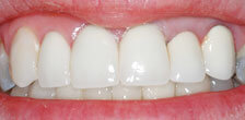CASE #19: Emergency Treatment - Fractured Tooth (after) CASE #19: Emergency Treatment - Fractured Tooth (after)
