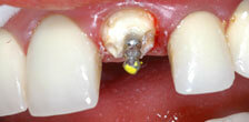 CASE #19: Emergency Treatment - Fractured Tooth (before) CASE #19: Emergency Treatment - Fractured Tooth (before)