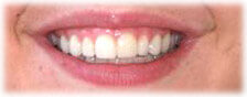 CASE # 2: Cosmetic Dentistry - Lumineers (after) CASE # 2: Cosmetic Dentistry - Lumineers (after)