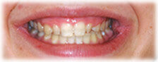 CASE # 2: Cosmetic Dentistry - Lumineers (before) CASE # 2: Cosmetic Dentistry - Lumineers (before)