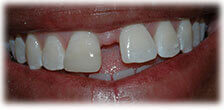 CASE #21: Emergency Treatment - Fractured Tooth (after) CASE #21: Emergency Treatment - Fractured Tooth (after)