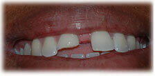 CASE #21: Emergency Treatment - Fractured Tooth (before) CASE #21: Emergency Treatment - Fractured Tooth (before)