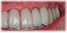 CASE #22: Cosmetic Restoration (after) CASE #22: Cosmetic Restoration (after)