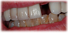 CASE #22: Cosmetic Restoration (before) CASE #22: Cosmetic Restoration (before)