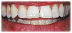 CASE #23: Emergency Treatment - Fractured Tooth (after) CASE #23: Emergency Treatment - Fractured Tooth (after)