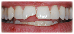 CASE #23: Emergency Treatment - Fractured Tooth (before) CASE #23: Emergency Treatment - Fractured Tooth (before)