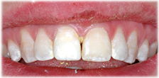 CASE #24: Broken / fractured tooth (after) CASE #24: Broken / fractured tooth (after)