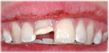CASE #24: Broken / fractured tooth (before) CASE #24: Broken / fractured tooth (before)