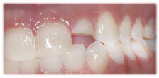 CASE #25: Emergency Treatment - Fractured Tooth (before) CASE #25: Emergency Treatment - Fractured Tooth (before)