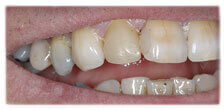 CASE #26: Broken / fractured Tooth (after) CASE #26: Broken / fractured Tooth (after)