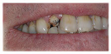 CASE #26: Broken / fractured Tooth (before) CASE #26: Broken / fractured Tooth (before)