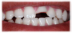 CASE #27: Emergency Treatment - Fractured Tooth (before) CASE #27: Emergency Treatment - Fractured Tooth (before)