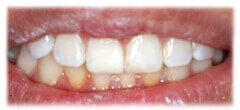 CASE #28: Broken / fractured tooth (after) CASE #28: Broken / fractured tooth (after)