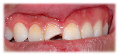 CASE #28: Broken / fractured tooth (before) CASE #28: Broken / fractured tooth (before)