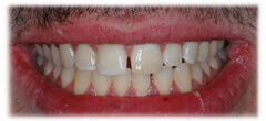 CASE #29: Emergency Treatment - Broken Teeth (after) CASE #29: Emergency Treatment - Broken Teeth (after)
