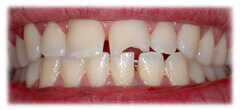 CASE #29: Emergency Treatment - Broken Teeth (before) CASE #29: Emergency Treatment - Broken Teeth (before)