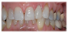 CASE # 3: Emergency Treatment - Fractured or Broken Tooth (after) CASE # 3: Emergency Treatment - Fractured or Broken Tooth (after)