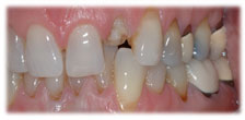 CASE # 3: Emergency Treatment - Fractured or Broken Tooth (before) CASE # 3: Emergency Treatment - Fractured or Broken Tooth (before)