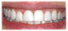 CASE #30: Cosmetic Lengthening (after) CASE #30: Cosmetic Lengthening (after)