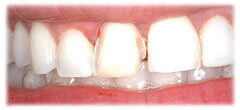 CASE #30: Cosmetic Lengthening (before) CASE #30: Cosmetic Lengthening (before)