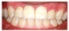CASE #31: Cosmetic Restoration (after) CASE #31: Cosmetic Restoration (after)