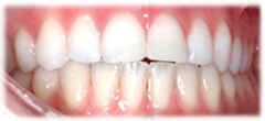 CASE #33: Emergency Treatment - Fractured Tooth (after) CASE #33: Emergency Treatment - Fractured Tooth (after)