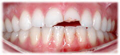 CASE #33: Emergency Treatment - Fractured Tooth (before) CASE #33: Emergency Treatment - Fractured Tooth (before)