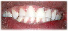 CASE #34: Emergency Treatment - Fractured Tooth (after) CASE #34: Emergency Treatment - Fractured Tooth (after)