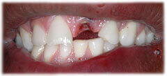CASE #34: Emergency Treatment - Fractured Tooth (before) CASE #34: Emergency Treatment - Fractured Tooth (before)