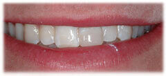 CASE #35: Broken / fractured tooth (after) CASE #35: Broken / fractured tooth (after)