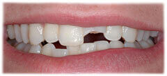 CASE #35: Broken / fractured tooth (before) CASE #35: Broken / fractured tooth (before)