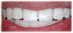CASE #36: Emergency Treatment - Broken tooth (after) CASE #36: Emergency Treatment - Broken tooth (after)