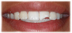 CASE #36: Emergency Treatment - Broken tooth (before) CASE #36: Emergency Treatment - Broken tooth (before)
