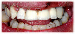 CASE #37: Broken / fractured tooth (after) CASE #37: Broken / fractured tooth (after)